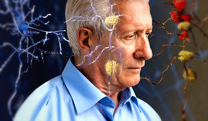 Alzheimer-Karnozin-Extra