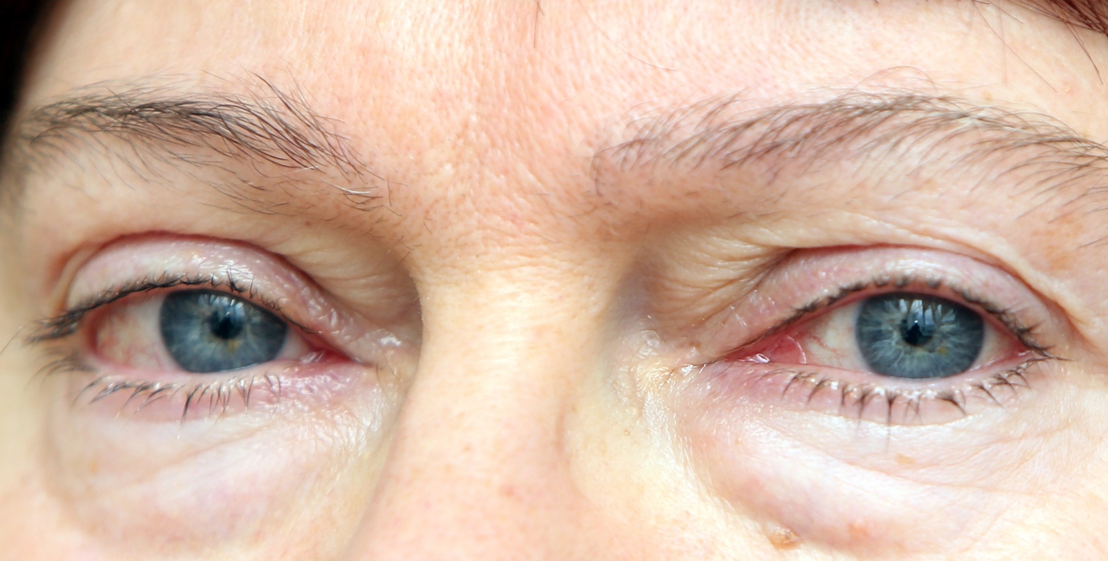 Konjuktivitis Konjuktivitis