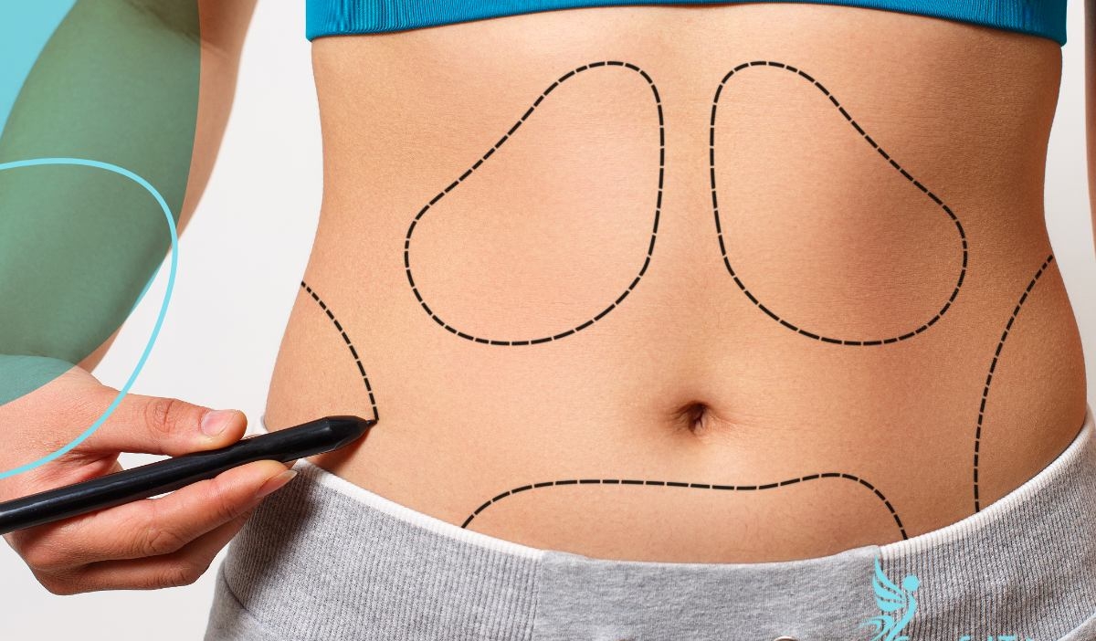 liposuction1617612452