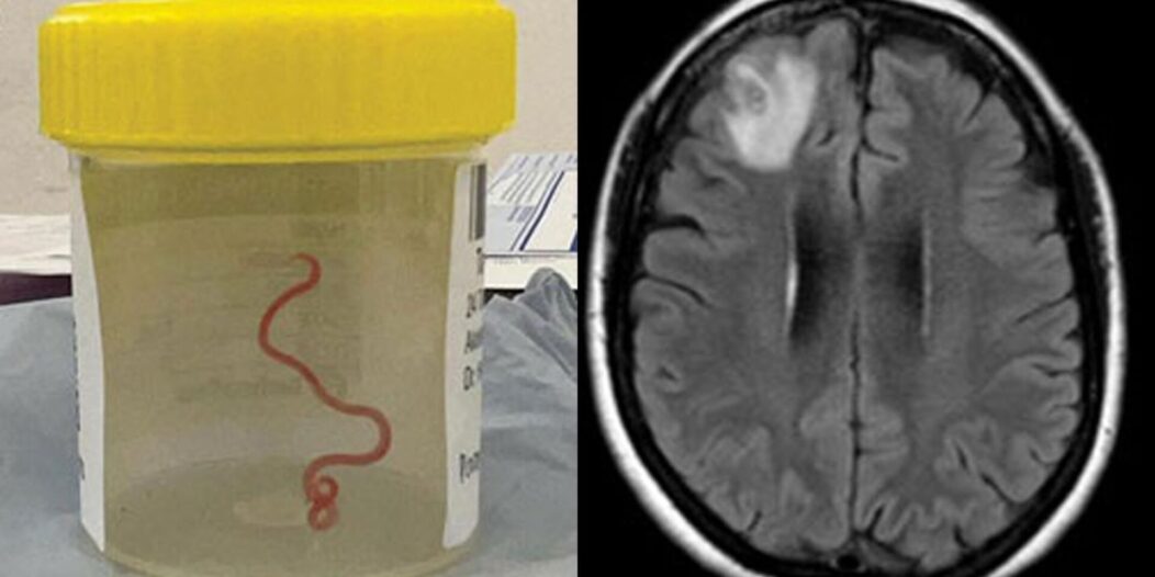 skynews-worms-brain-scan_6266211 skynews-worms-brain-scan_6266211