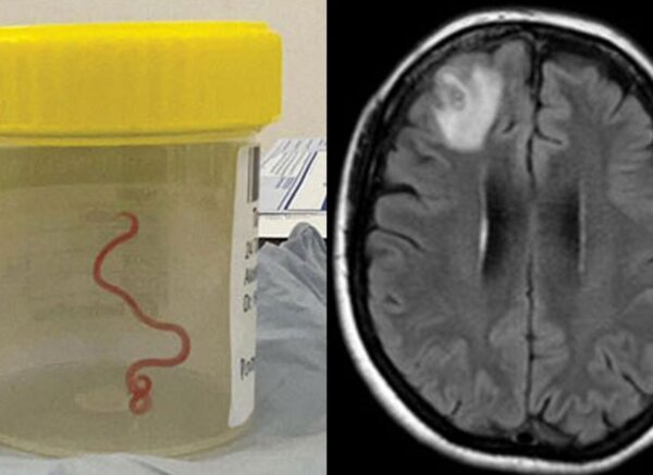 skynews-worms-brain-scan_6266211